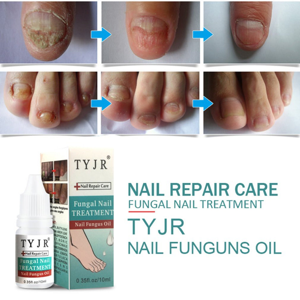 10ML Natural Formula Fungal Nail Treatment Feet Care Essence Nail Foot Whitening Toe Nail Fungus Removal Gel Liquid 2018 sell - ebowsos