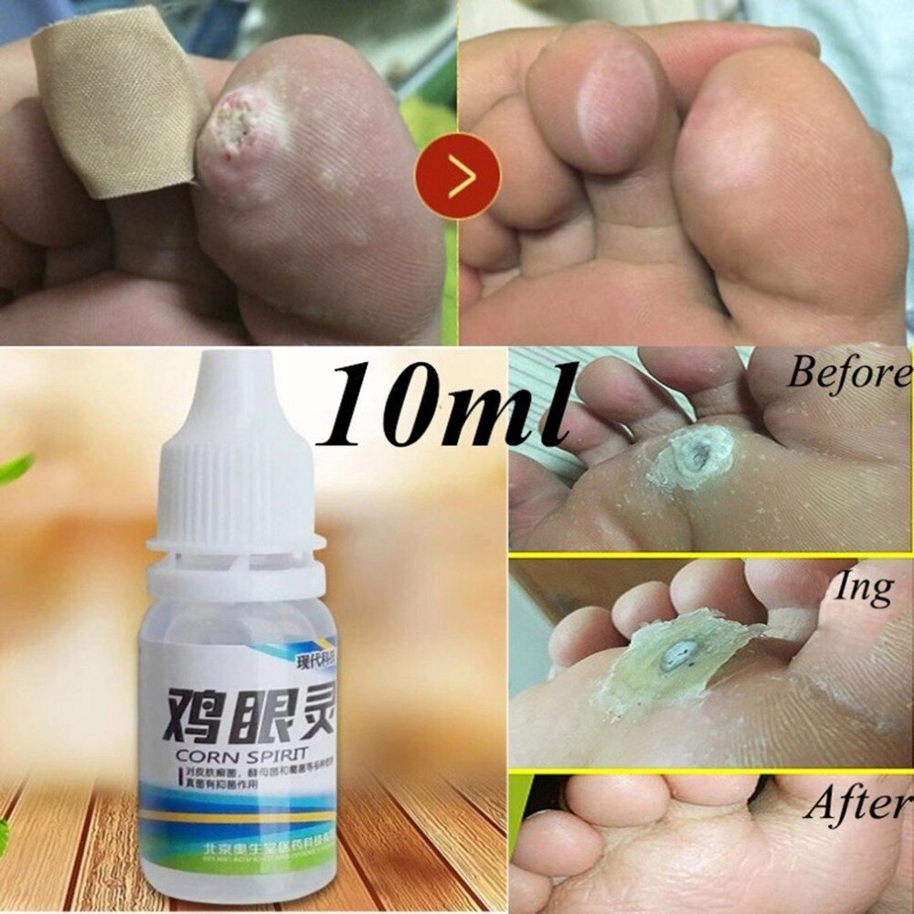10ml Powerful Foot Corn Remover Useful Foot Callus Remover Liquid Foot Corn Foot Care Liquid - ebowsos