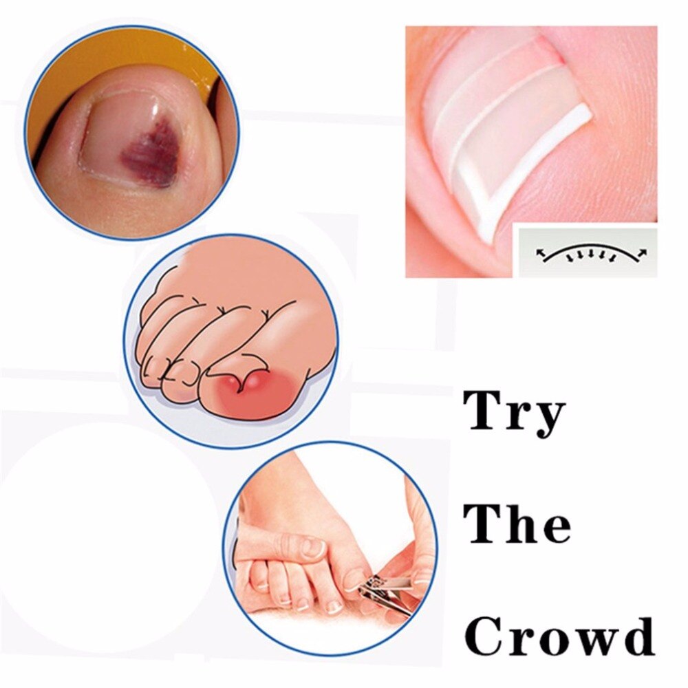 10pcs Ingrown Straightening Clip Curved BS Brace Toenail Patch Lifter Fixer Recover Thick Paronychia Correction Pedicure Tool - ebowsos