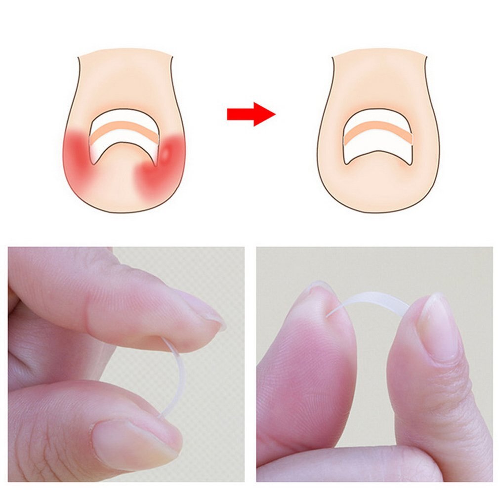 10pcs/box Ingrown Toenail Correction Straightening Clip Toe Nail Sticker Patch Correction Pedicure Foot Care Tool - ebowsos