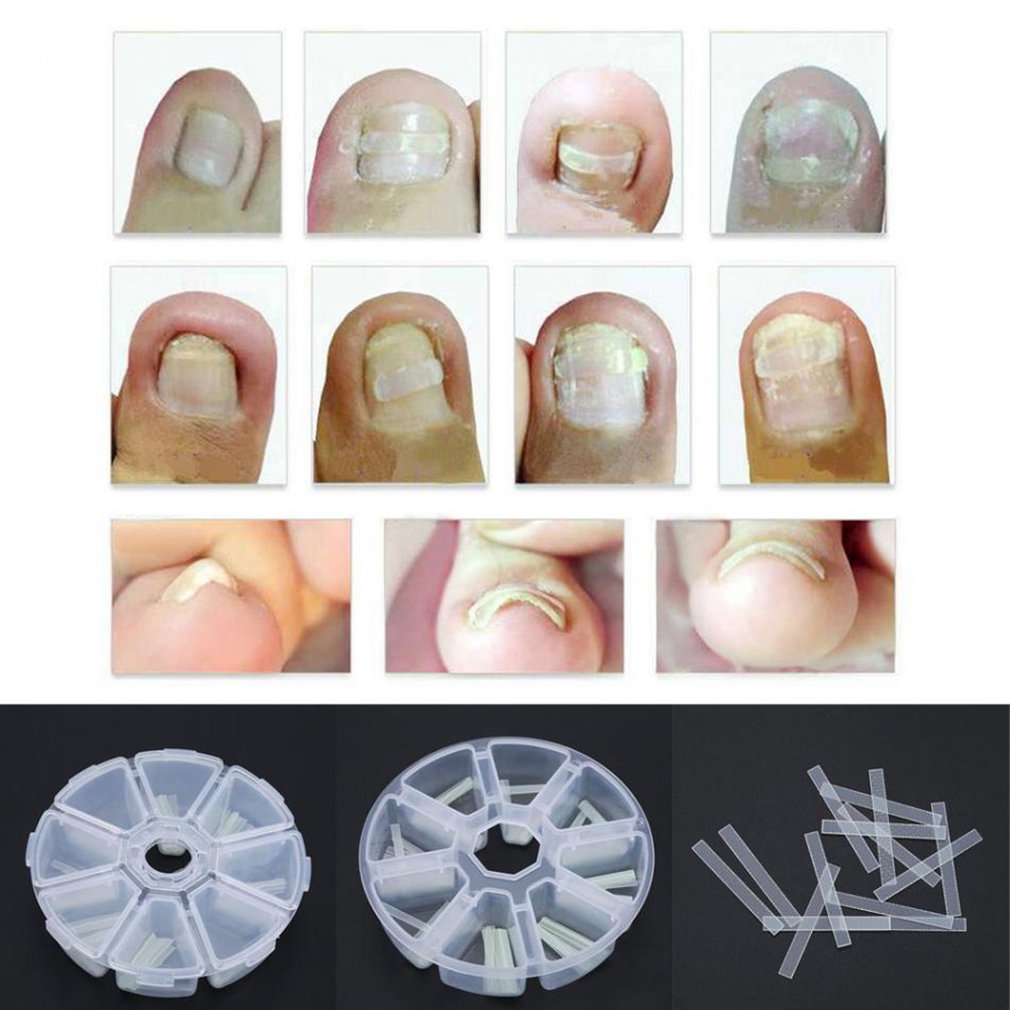 120pcs/box Ingrown Toenail Correction Straightening Clip Toe Nail Sticker Patch Correction Pedicure Foot Care Tool - ebowsos