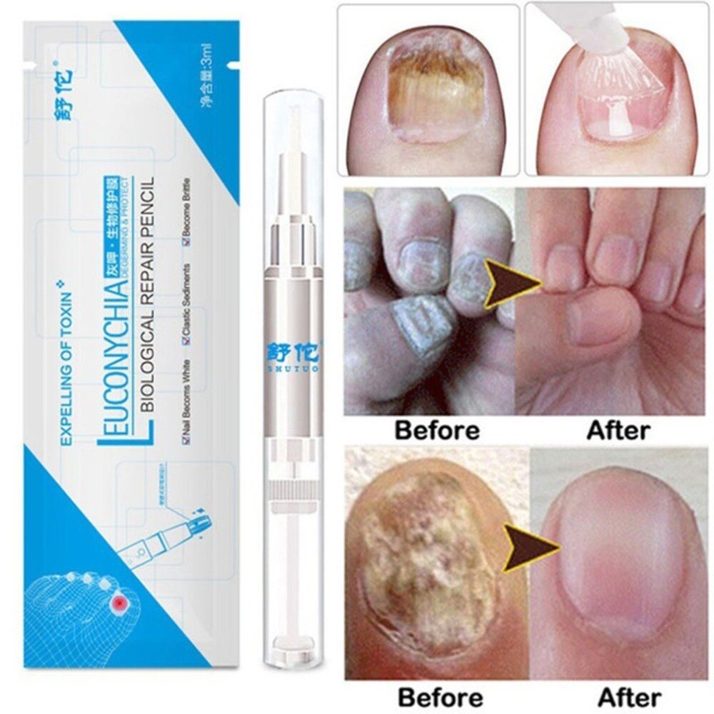 3ml Nail Treatment Pen Fungal Nail Treatment Essence Liquid Whitening Toe Nail Fungus Removal Nail Art Tool - ebowsos