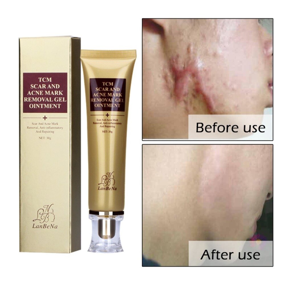 LANBENA 30G Primer Natural Organic Acne Scar Removal Cream Skin Repair Face Care Cream Acne Spot Treatment Bleaching - ebowsos