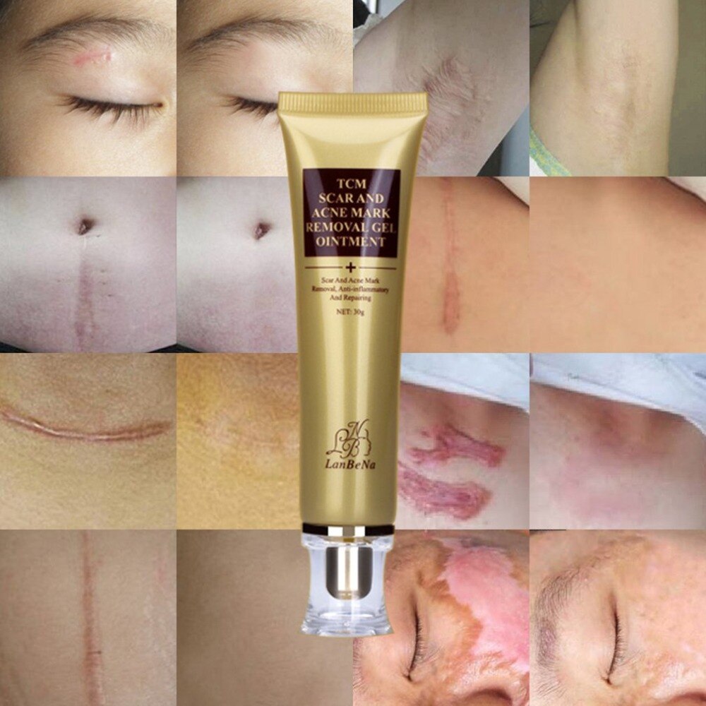 LANBENA 30G Primer Natural Organic Acne Scar Removal Cream Skin Repair Face Care Cream Acne Spot Treatment Bleaching - ebowsos