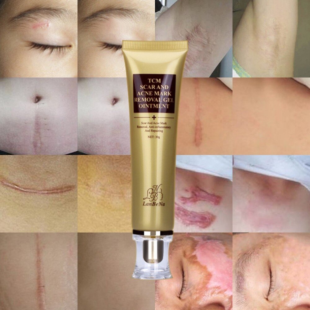 LANBENA ginseng extract against black dots cream scar removal facial blackhead acne skin care treatment bleaching cream 30ml - ebowsos