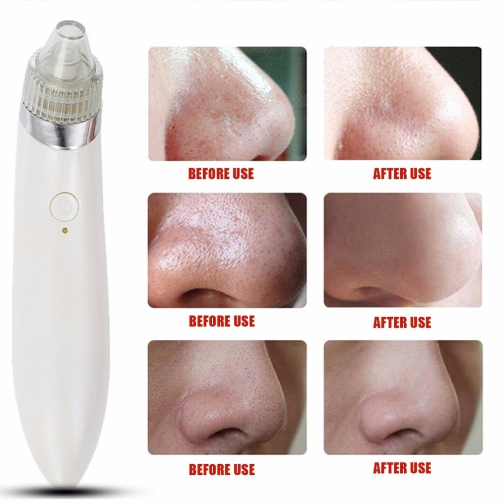 Pro Ultrasonic Vibration Electric Blackhead Vacuum Suction Remover Vacuum Face Pore Spot Cleaner Beauty Facial Skin Care Tool - ebowsos