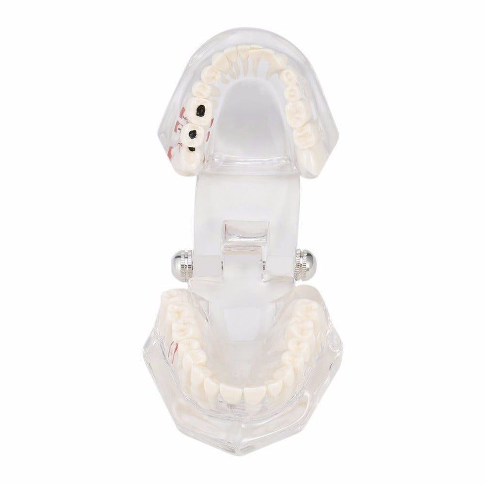 Professional Detachable Fake Tooth Teeth Disease Moldel Dental Implant Restoration Display Clinic Hospital Educational Use New - ebowsos